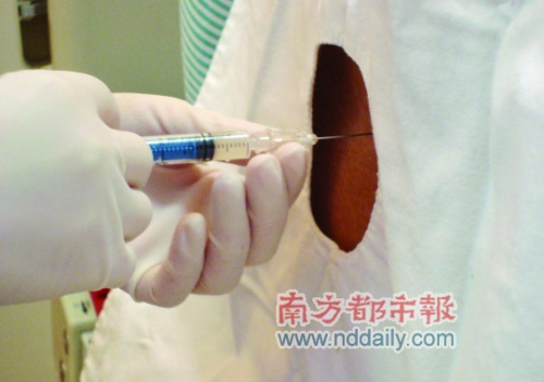  中国医生将一根针插入病人的脊髓，注入从脐带血中分离出的干细胞，而这一针收费一万元人民币。据记者了解，外国病人全程治疗费需二三十万元人民币。　广东省中医院大学城分院供图