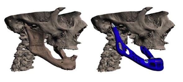 比利时科学家研制世界首个3D打印颚骨(图)