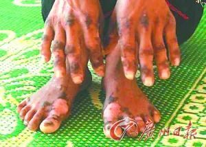 感染这种皮肤病后，患者手掌和脚掌皮肤会发炎长疮，之后硬成角质。严重者会因器官衰竭而死亡。资料图