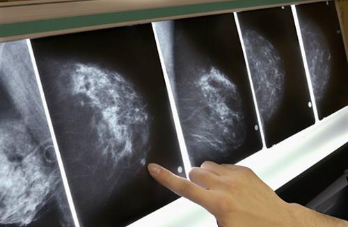 十大医学突破：基因扫描查找乳腺癌