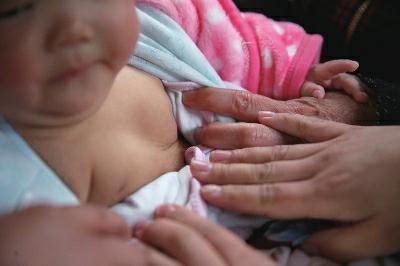 女婴双侧乳房“发育”