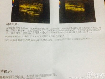 专家问答乳腺科朱新萍教授答如何防治乳腺纤维瘤三