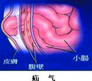 什么保险可以报销疝气手术 疝气手术商业保险报销