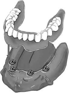活动牙频频卡喉真要命即刻种植仿生牙根深蒂固