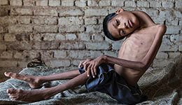 13岁男孩脖子横向生长