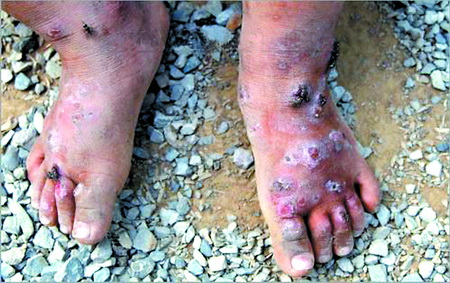 一个患有艾滋病呼儿童呼脚上长满疱疹
