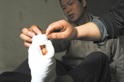 力哥脚趾被砸骨折 雇主三天后不管了