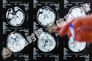 弓形虫入脑四岁男童生命垂危