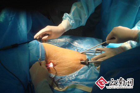 云南省首例完全采用全胸腔镜下肺叶切除术获成