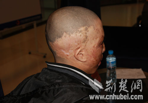 江西“阿西莫多男孩”在武汉接受“换脸术” 伊美尚资助10万元