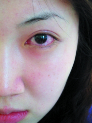 红眼兼发烧 暂不打麻疹疫苗