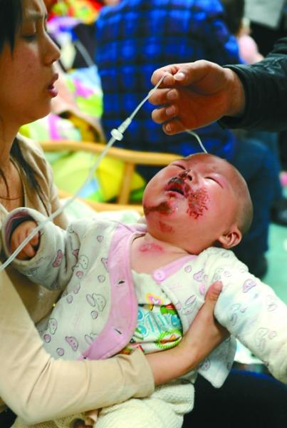 昨日，儿童医院，被烧伤的康康在医院接受治疗。 记者 张路桥 摄
