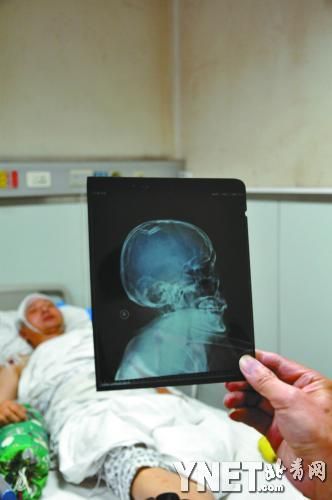 X光片显示李建利伤情严重。