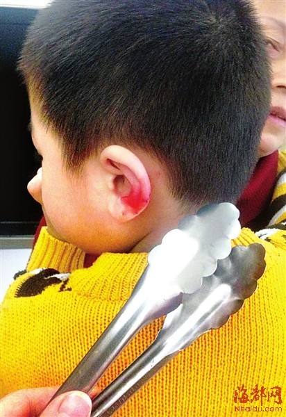 幼儿园三岁童耳朵受伤 称被阿姨用蛋糕夹夹伤