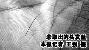 <em>男子</em>挠头<em>分叉</em>儿<em>头发</em>丝刺进手掌 深约1毫米_新