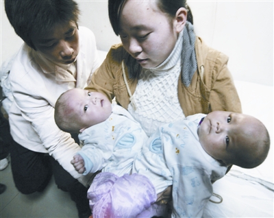 武汉协和医院成功分离罕见坐骨连体婴儿
