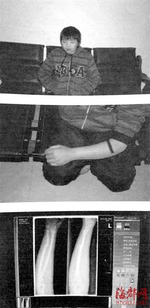 “碰瓷党”买少年断其手臂“撞车”诈钱