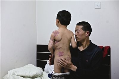 被狗咬伤男童来京求医