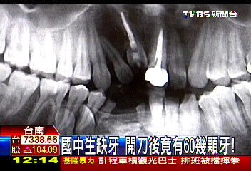 台湾初中生缺牙 手术后发现有60多颗牙