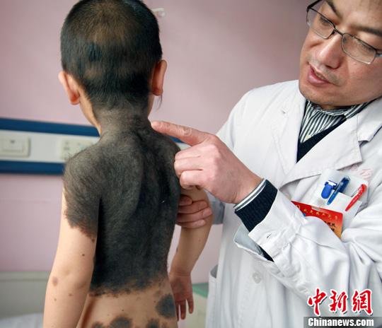 <em>三岁男童</em>患罕见巨型黑毛痣病 半身黑毛覆体(图