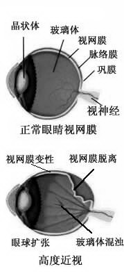 老人近视2500度需同时佩戴隐形与框架眼镜