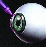 恐怖:眼睛激光手术原来是这样做的