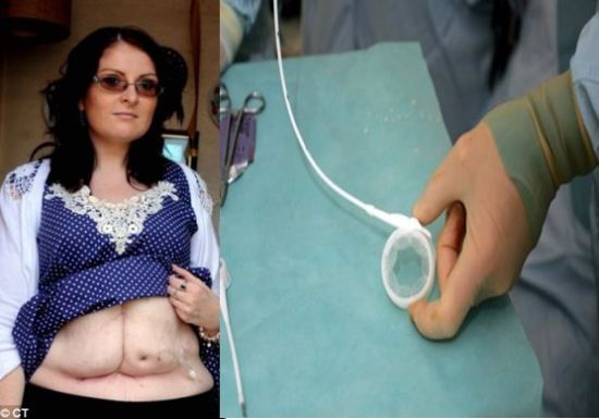 英国女子哈华斯戴上“束胃带”后成功减肥，但两年后出现并发症胃部“爆裂”，经紧急手术幸运存活。