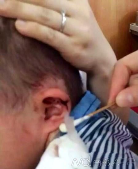 网帖贴出了男童耳朵缝针后的图片。来源:网友阳光南儿飞 网帖贴出了男童耳朵缝针后的图片。来源:网友阳光南儿飞