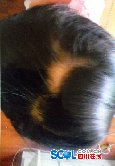 <em>3岁</em>女童<em>幼儿</em>园内7天2次受伤 <em>头发</em>被扯掉(图)|幼