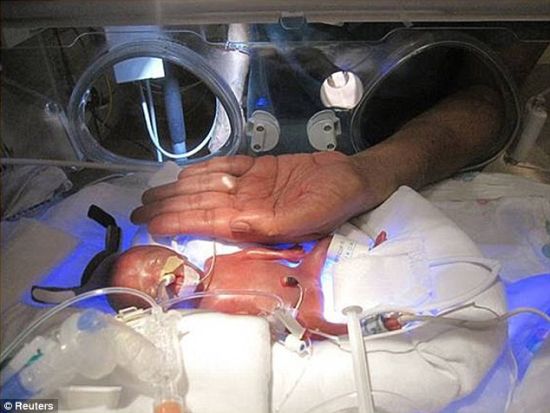 全球第三小婴儿奇迹存活出院回家 出生时体重