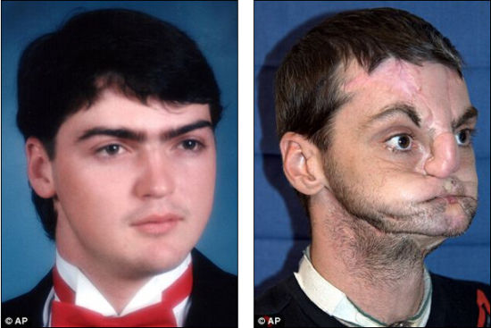 1997年诺里斯冲自己开枪,失去了鼻子和嘴唇,而且嘴巴几乎无法活动.