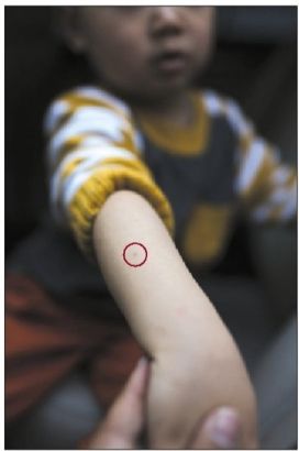 被扎幼童 针孔细小不易被发现