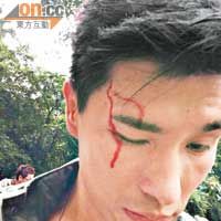 被玻璃碎弹中的陈展鹏，即流血