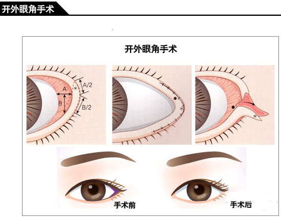 科技明眸指南 揭秘四种热门开眼角术|眼角|手术