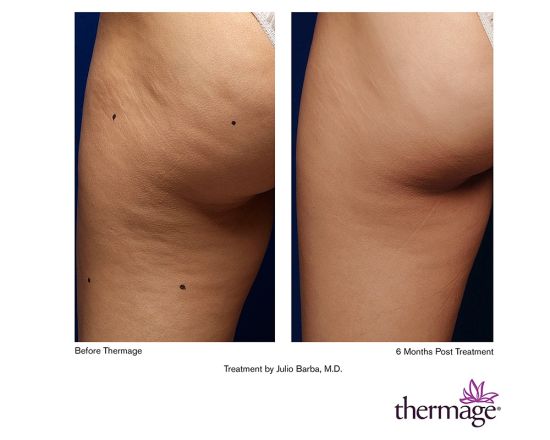 <em>热玛吉</em>_新浪健康_新浪网