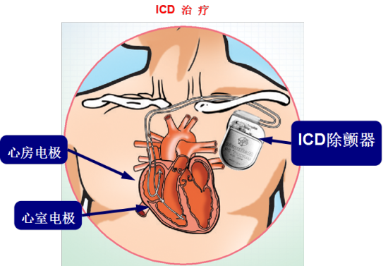 植入式除颤器对预防SCA是最成功的治疗