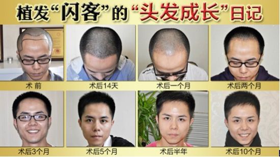 青<em>少</em>年脱发怎么办?浅析脱发原因_健康_新浪房