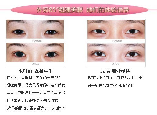 重庆做双眼皮的价格?割双眼皮手术效果好到美