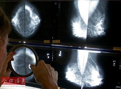 英国名医竟称癌症是“最佳死法”：痴呆症最可怕