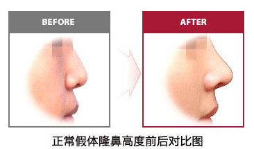 假体隆鼻过高小心鼻子变身透明鼻
