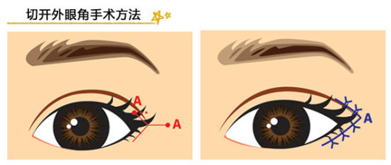 区分开内外眼角法 做吸睛大眼女|开眼角|区别