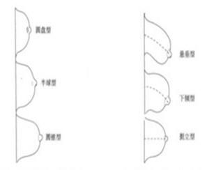 ⑥ 肥大型 成人未育女性肥大乳房主要由乳腺过度发育所致,少数由脂肪