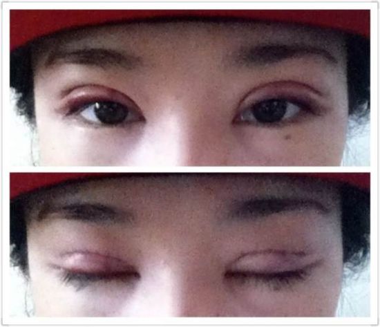双眼皮手术过程全纪录