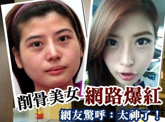 台湾26岁女子整容前后对比 台湾26岁女子整容前后对比