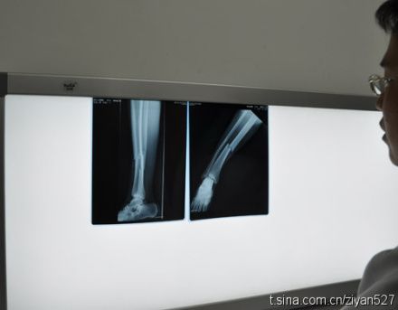 图文山东鲁能断腿小将入院治疗骨折x光照触目惊心