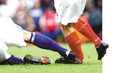 阿森纳前锋达·席尔瓦 遭断腿噩梦 导致小腿折断变形