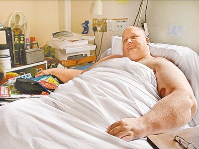 全球最胖男子接受缩胃手术减126公斤