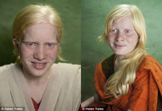 印度奇特家族成世界最大白化病家庭(组图)(2)