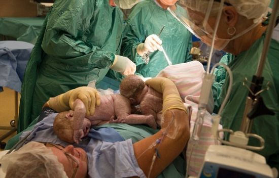 母亲分娩时自己用双手取出双胞胎