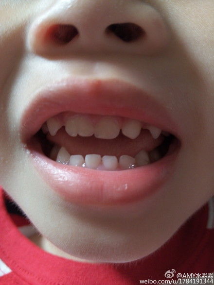 儿童牙齿正常咬合图片图片